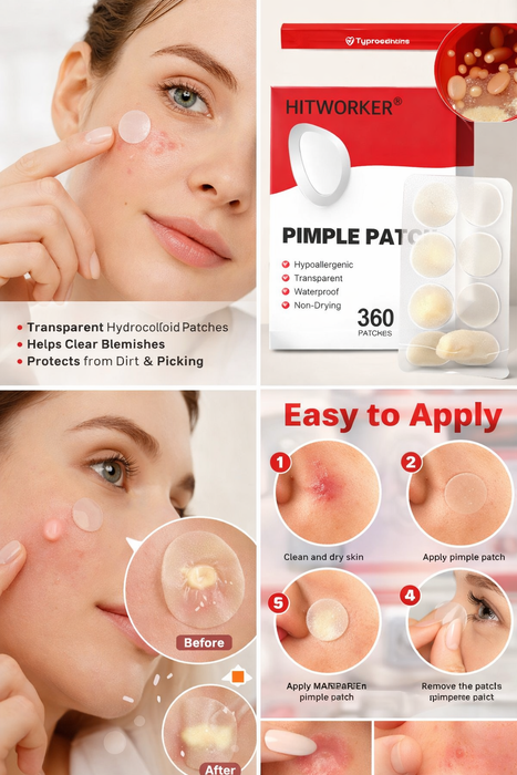 360Count Acne Patch Covers Pimple